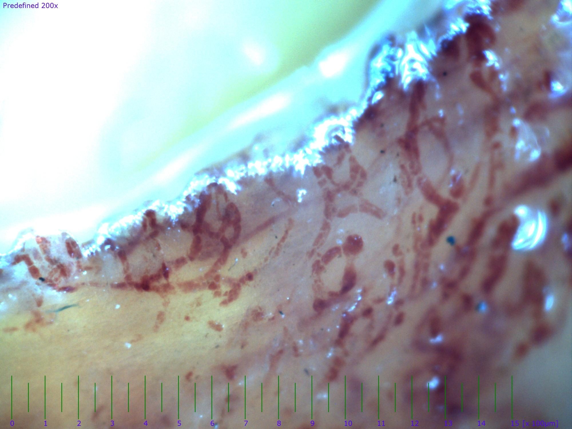 Capillaroscopy field from a critically ischemic digit with diffuse capillary thrombosis