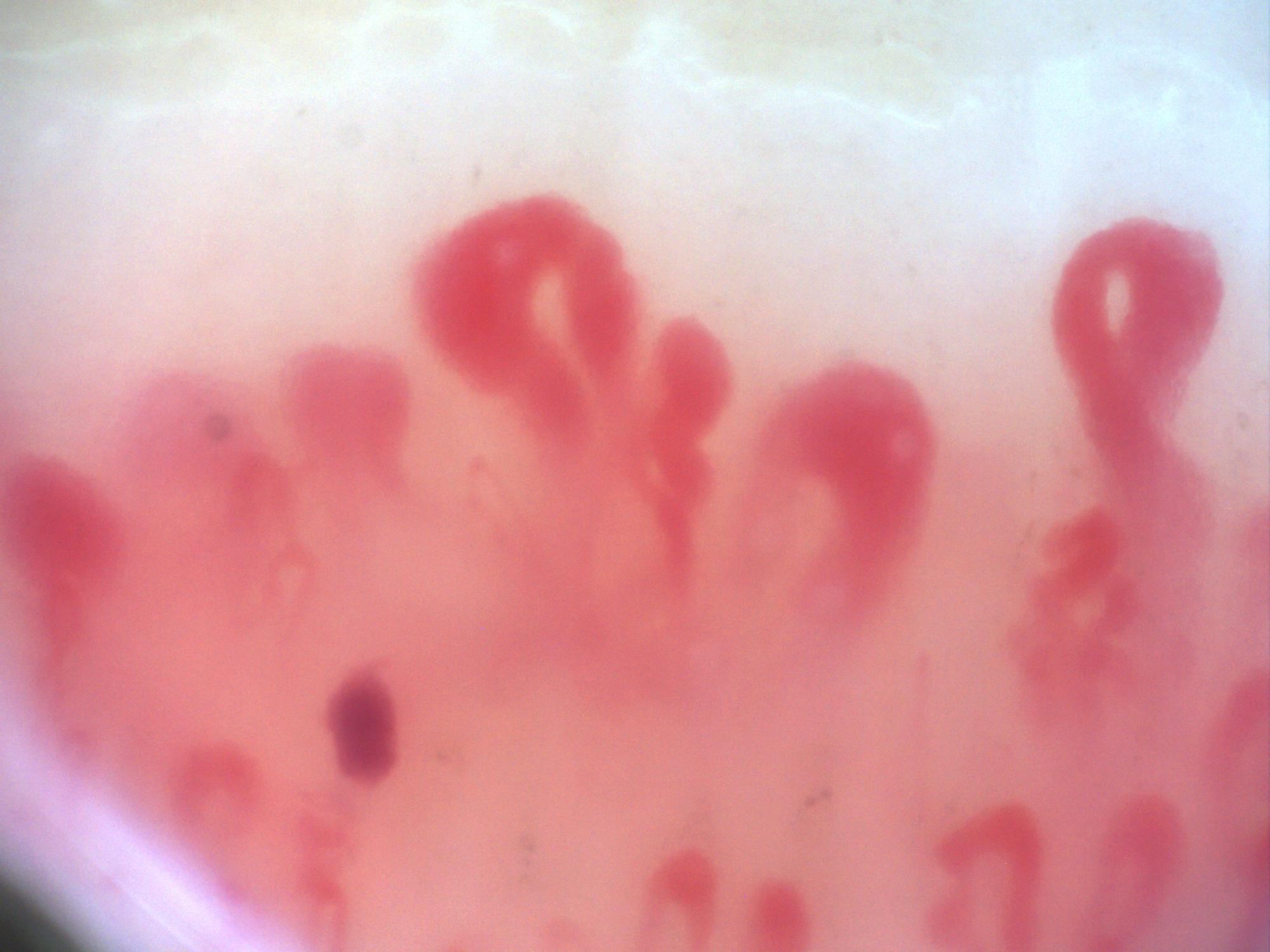 200x nailfold capillaroscopy field with large megacapillaries in an active scleroderma pattern