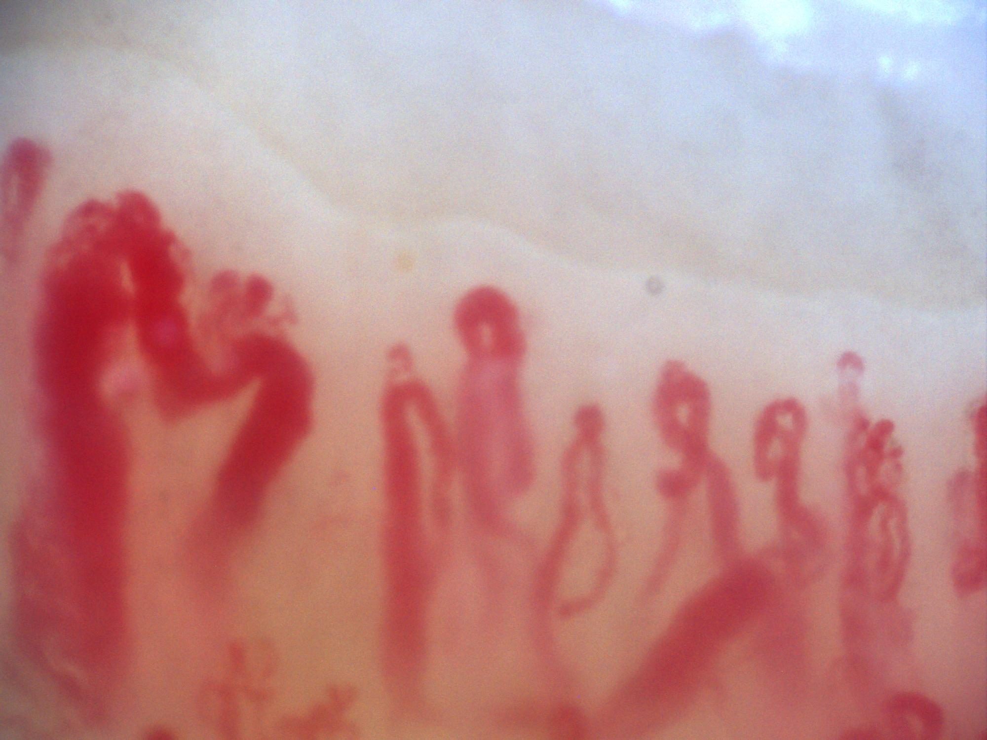 200x nailfold capillaroscopy field with several megacapillaries in an active scleroderma pattern