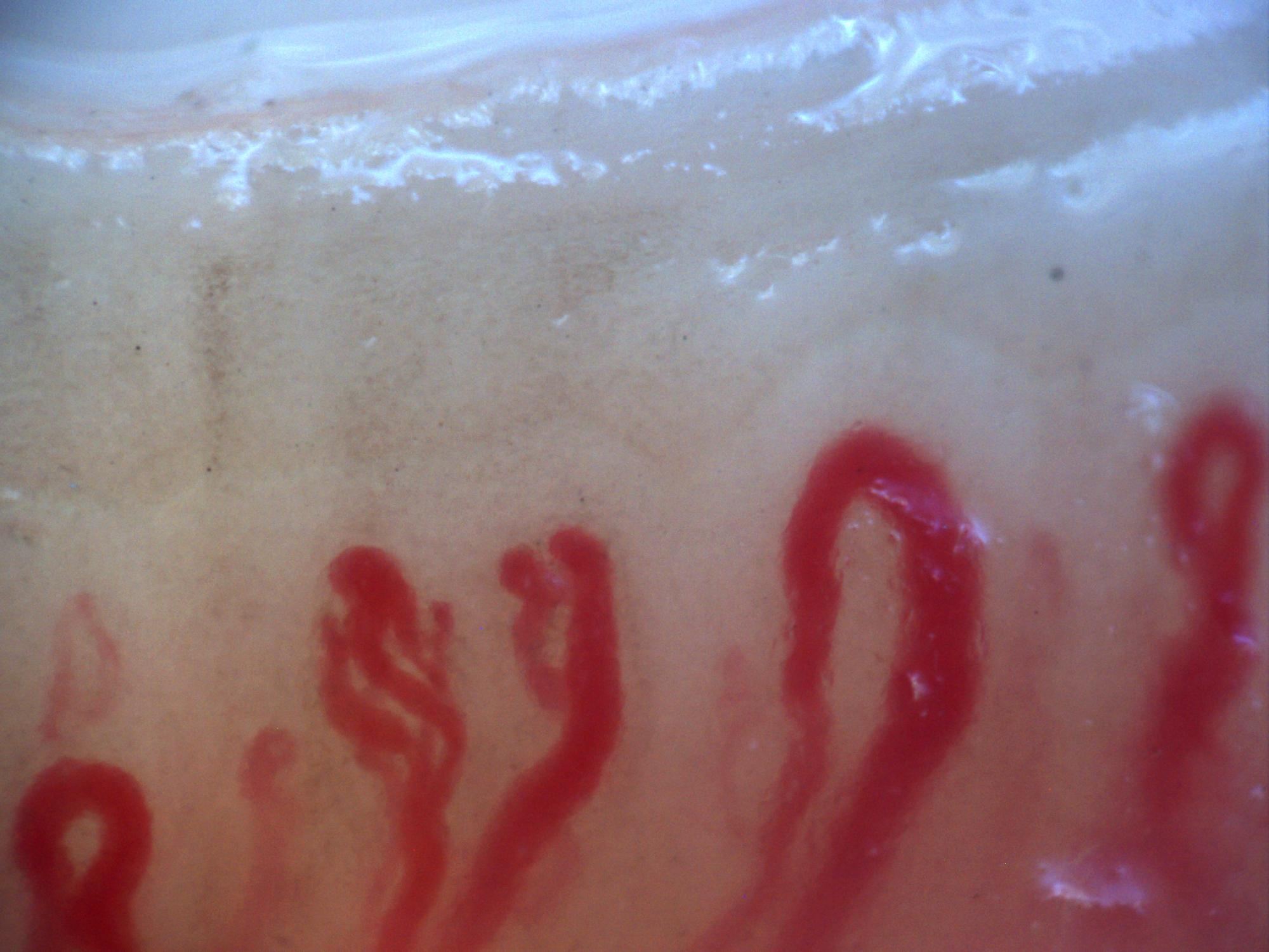 200x nailfold capillaroscopy field with prominent megacapillaries in an active scleroderma pattern