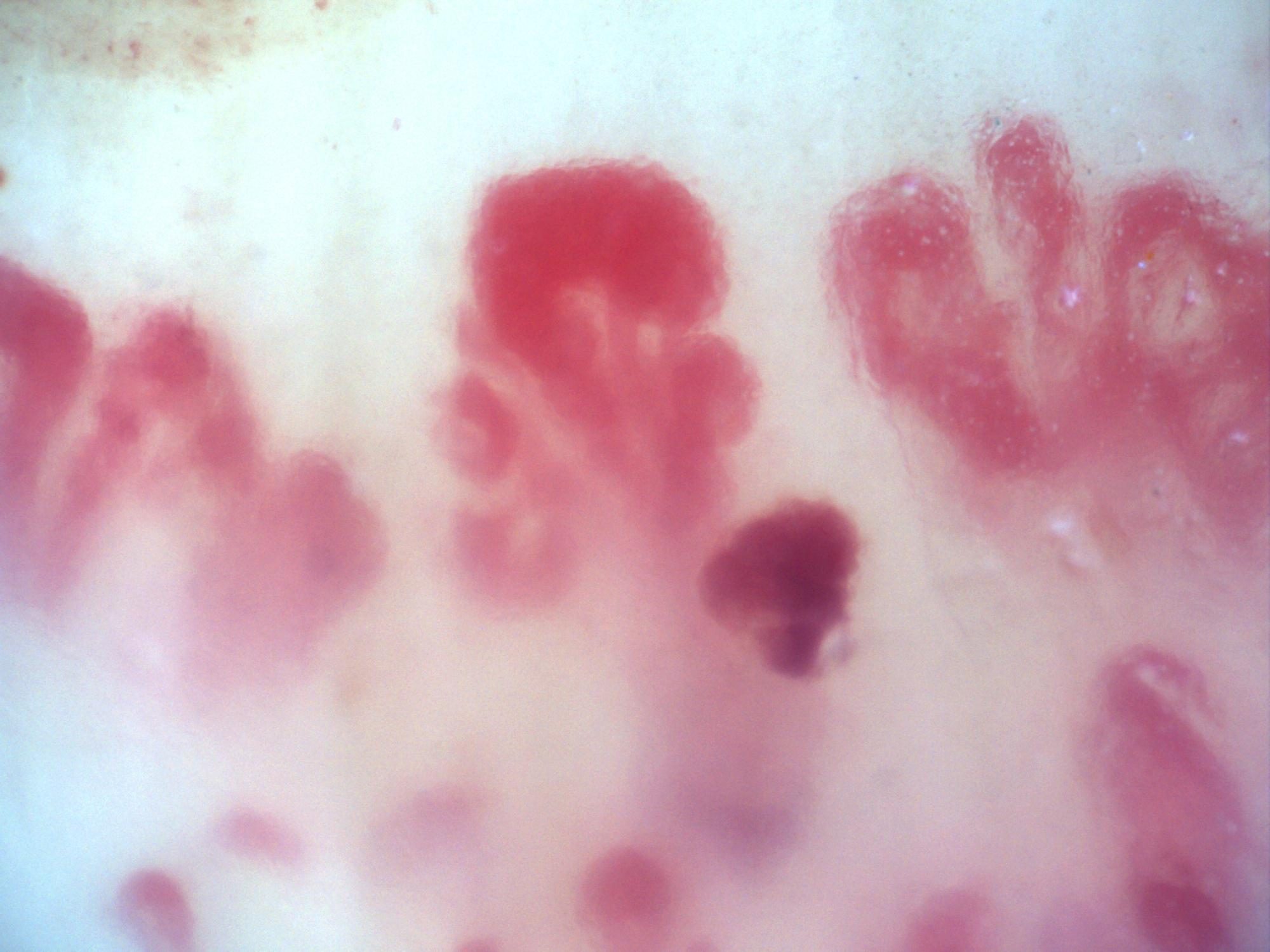 200x nailfold capillaroscopy field with visible megacapillaries in an active scleroderma pattern