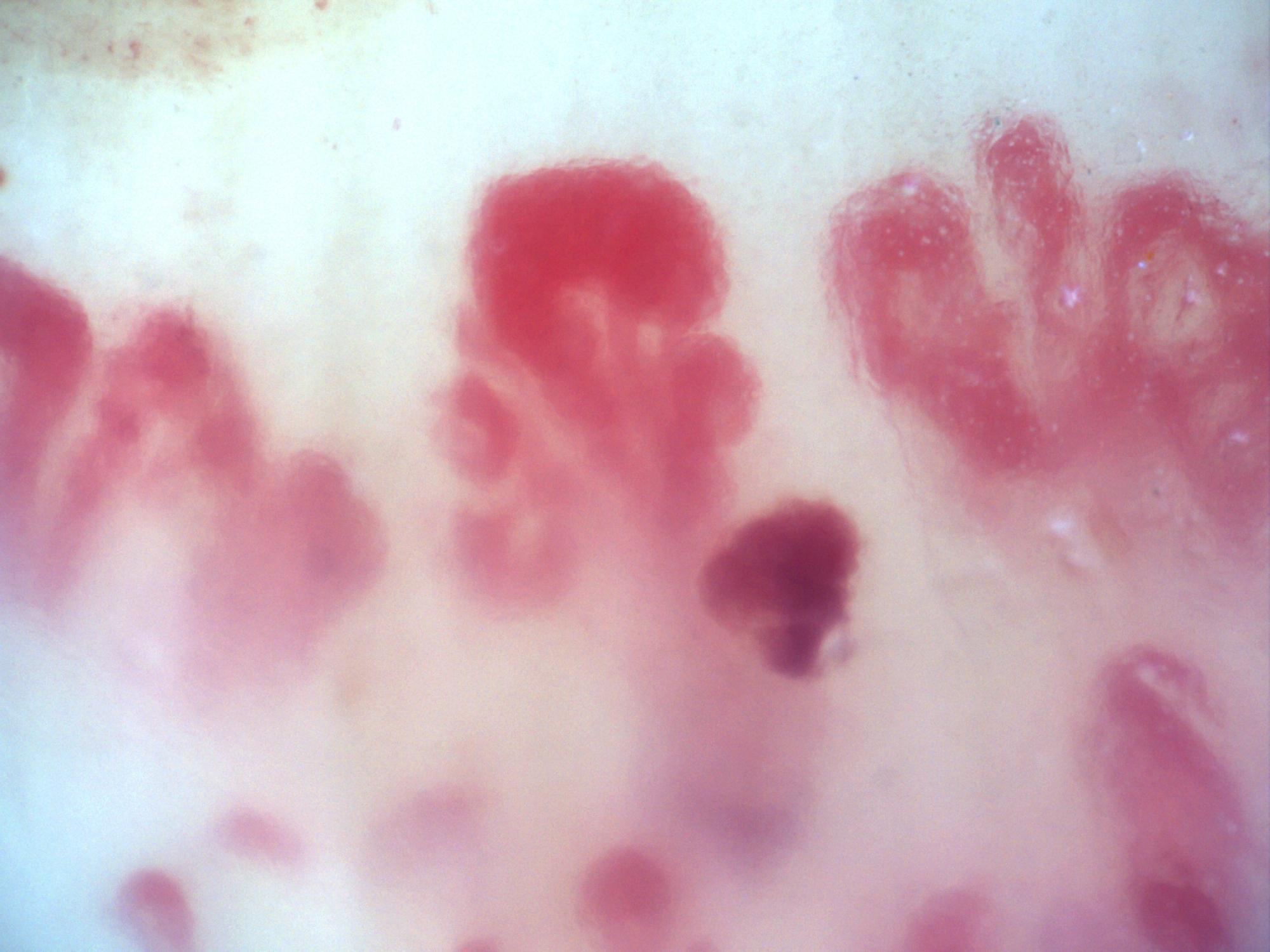 200x nailfold capillaroscopy field with visible megacapillaries in an active scleroderma pattern
