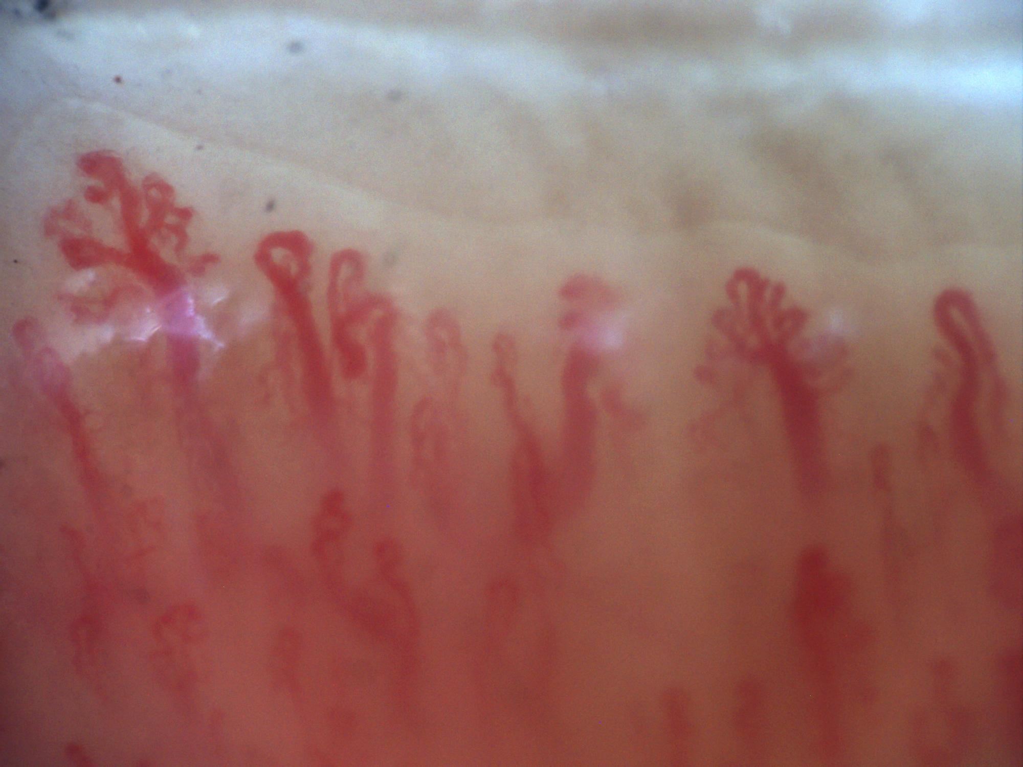 200x nailfold capillaroscopy field with a branching capillary on the left side