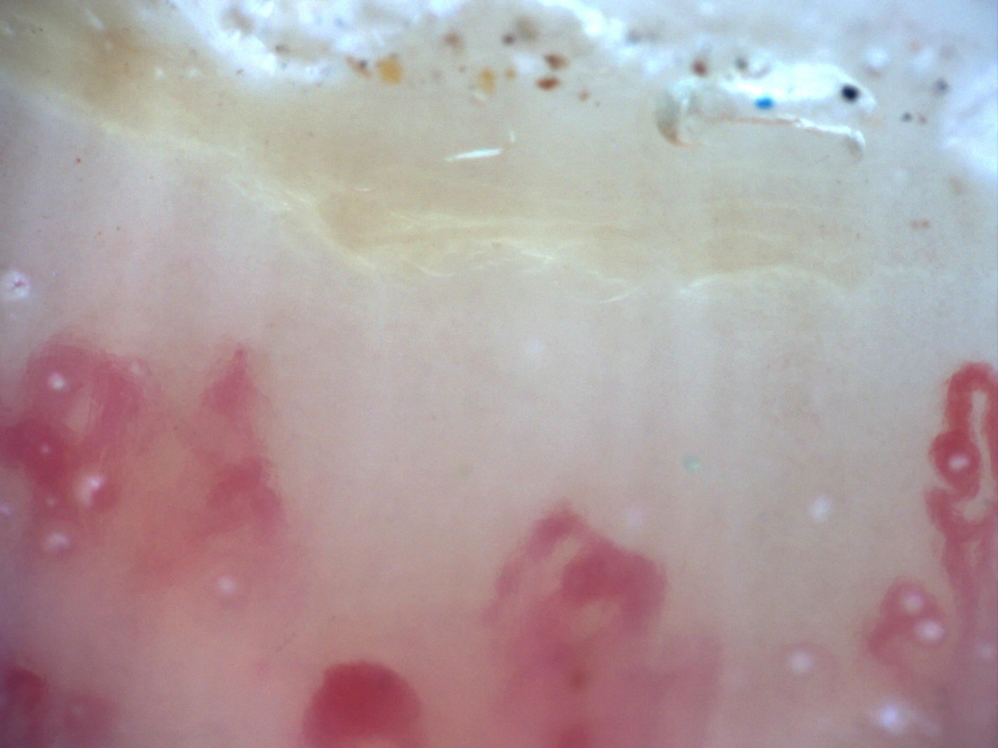 200x capillaroscopy field showing a broad capillary-free space compatible with an avascular area