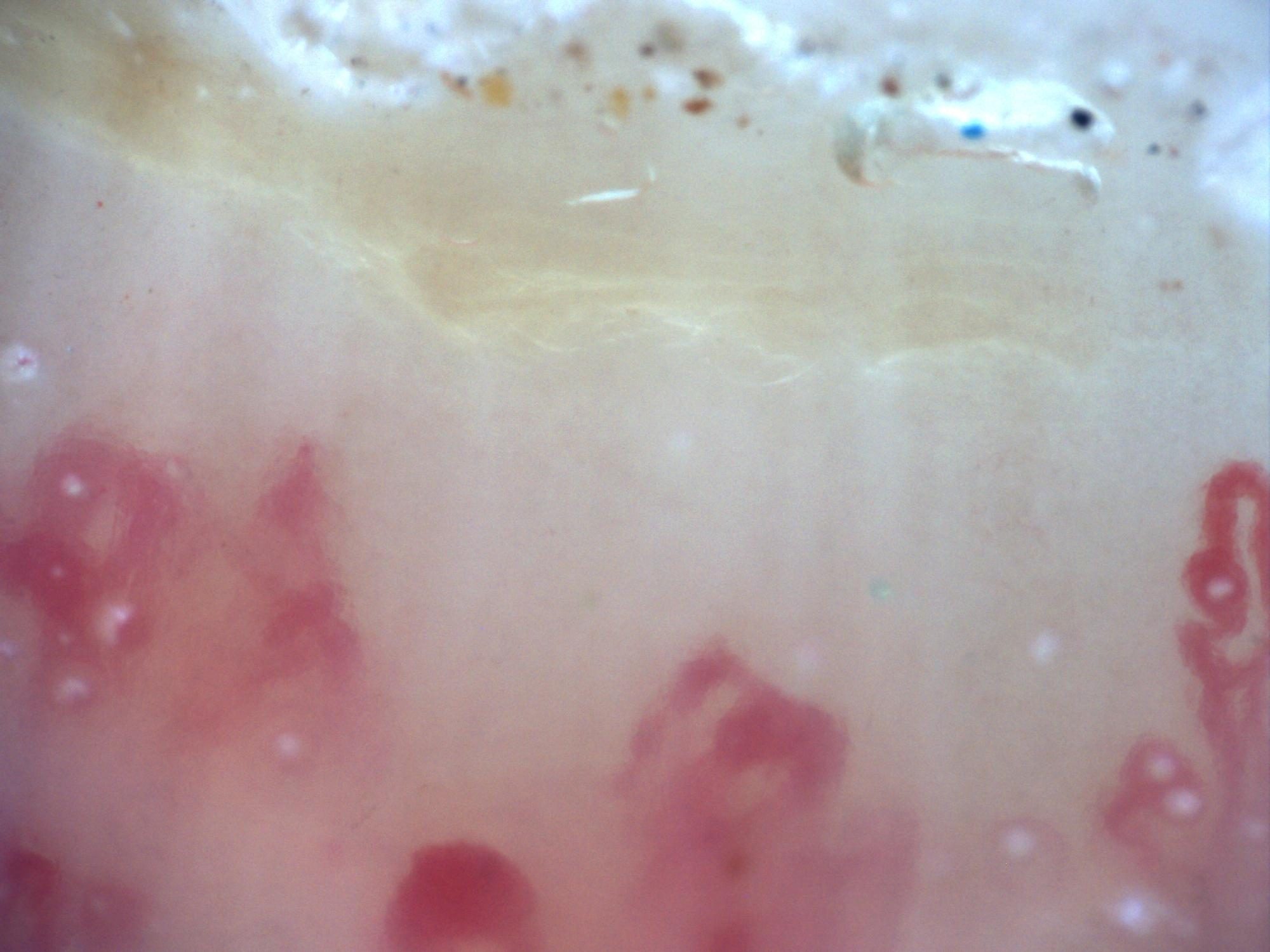 200x capillaroscopy field showing a broad capillary-free space compatible with an avascular area