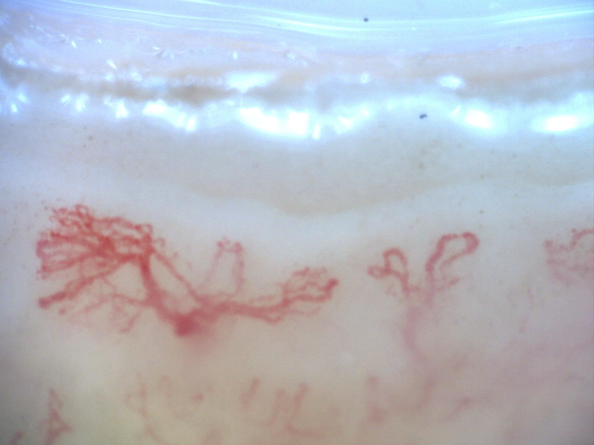 200x capillaroscopy field from systemic sclerosis showing marked architectural disorganization and neoangiogenesis without megacapillaries