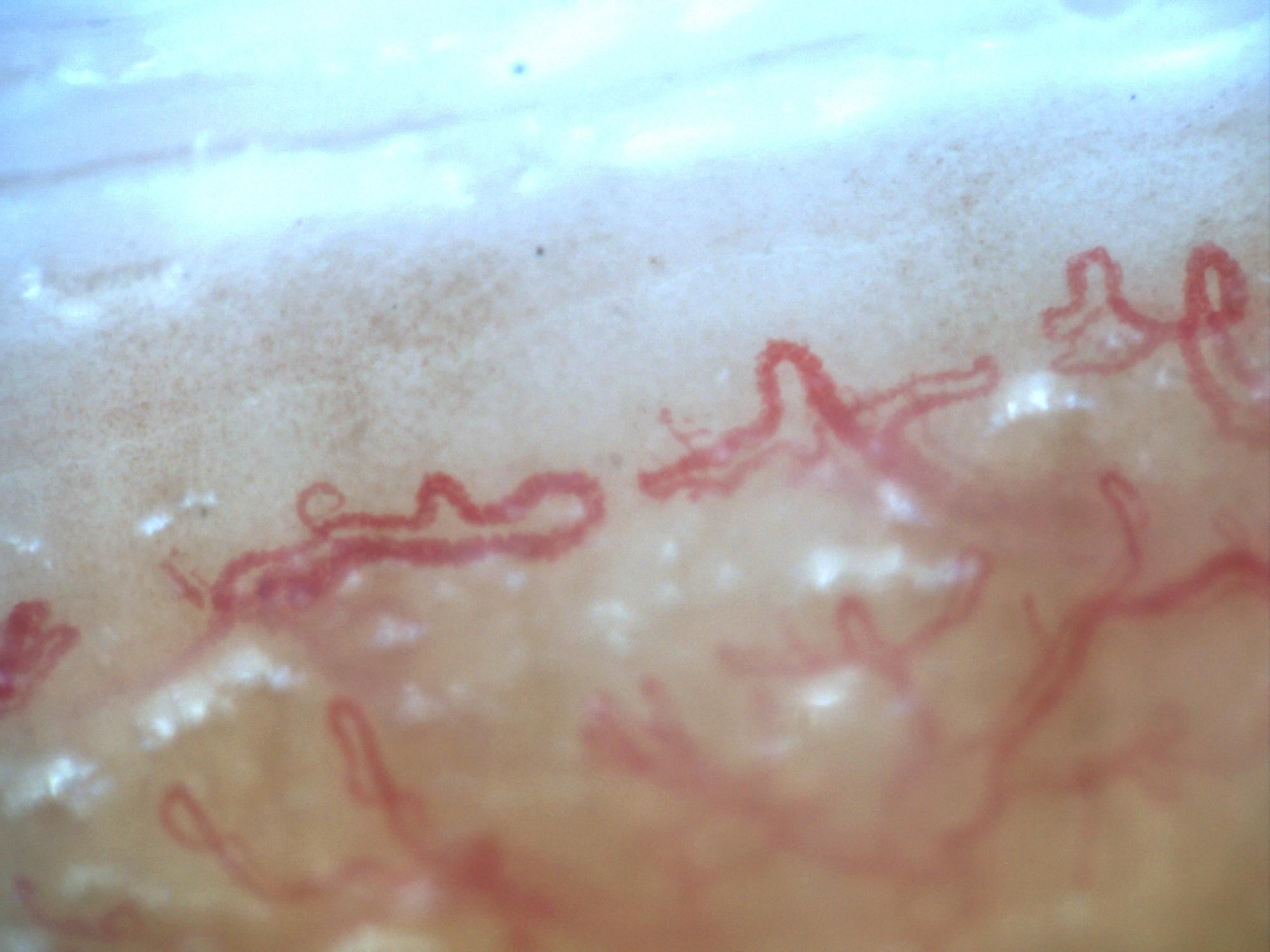 200x capillaroscopy field from systemic sclerosis showing severe architectural disorganization and neoangiogenesis without megacapillaries