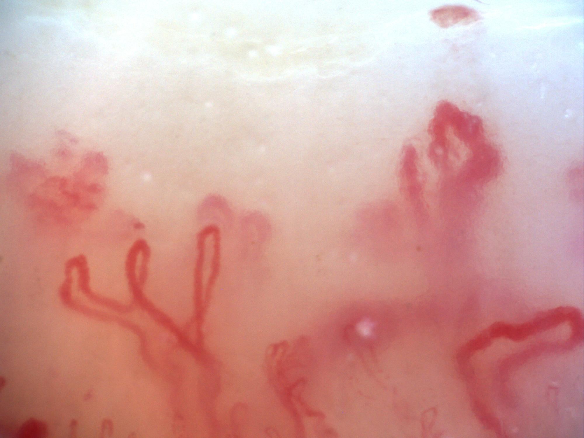 200x capillaroscopy field with a fog-like pericapillary haze between capillaries consistent with pericapillary edema
