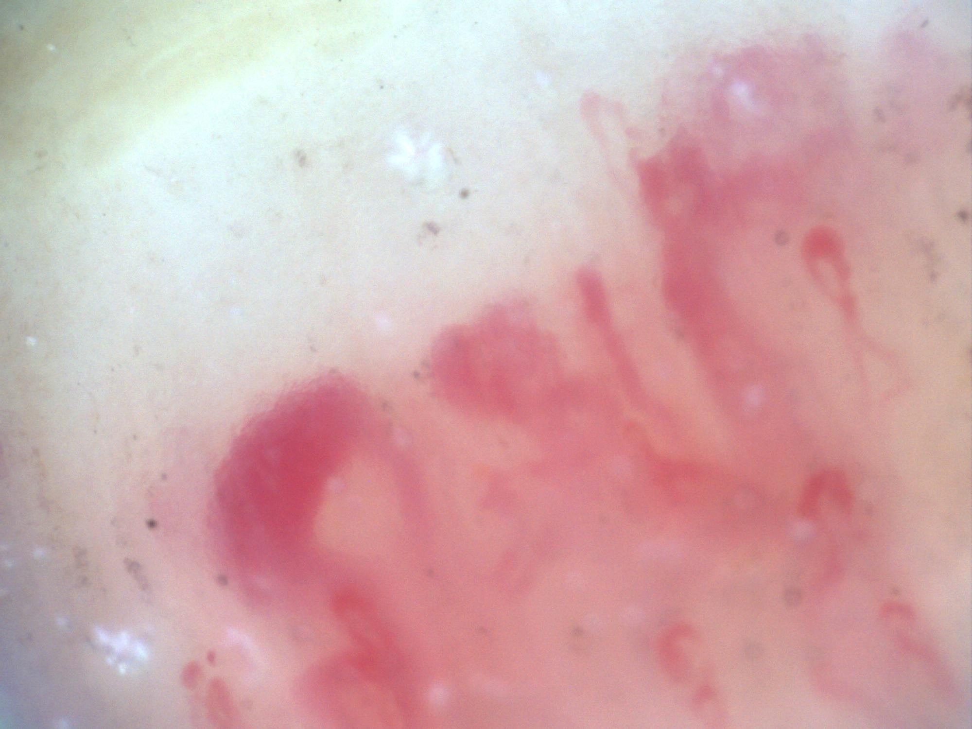 200x capillaroscopy field in systemic sclerosis showing megacapillaries with a ground-glass stromal appearance suggestive of fibrosis