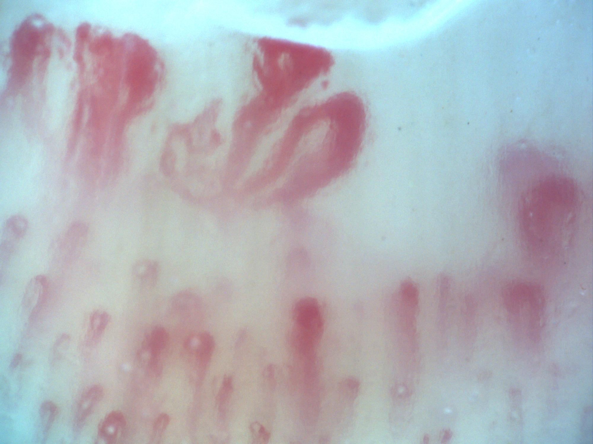 200x capillaroscopy field in systemic sclerosis showing megacapillaries, pericapillary edema, and a ground-glass stromal pattern