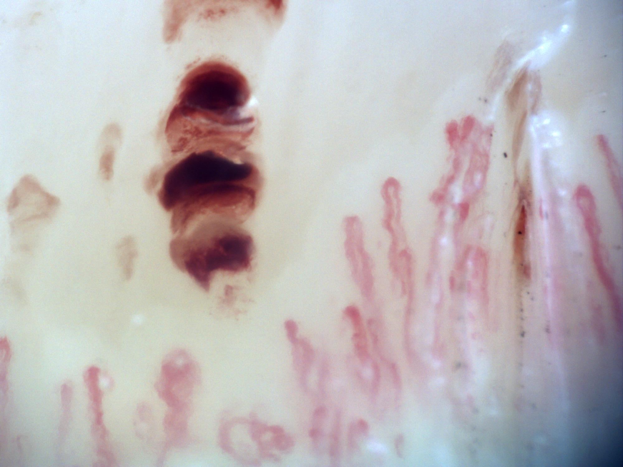 200x capillaroscopy field in systemic sclerosis showing a representative microvascular hemorrhagic lesion