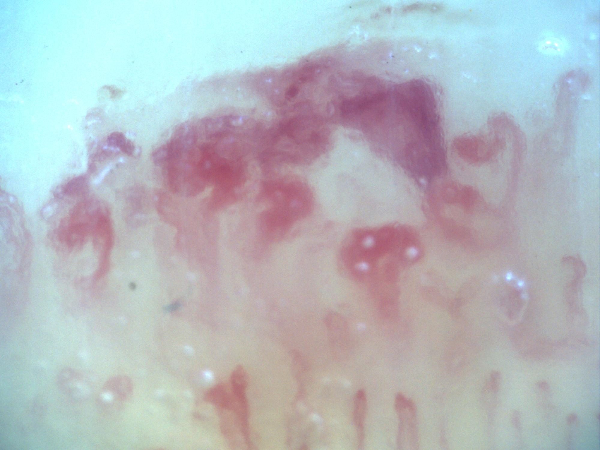 200x capillaroscopy field in systemic sclerosis showing a hemorrhage with a smoke-plume appearance
