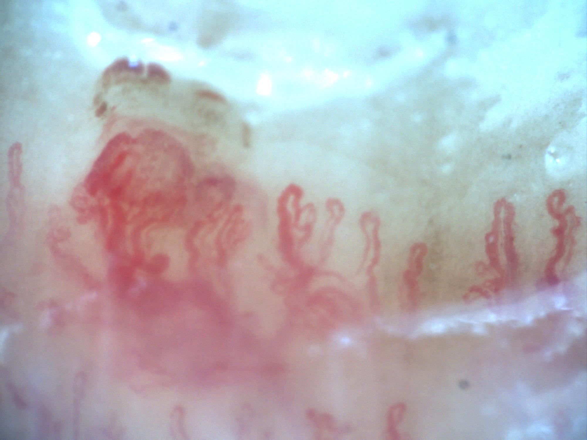 200x capillaroscopy field capturing a hemorrhage at the moment of its formation