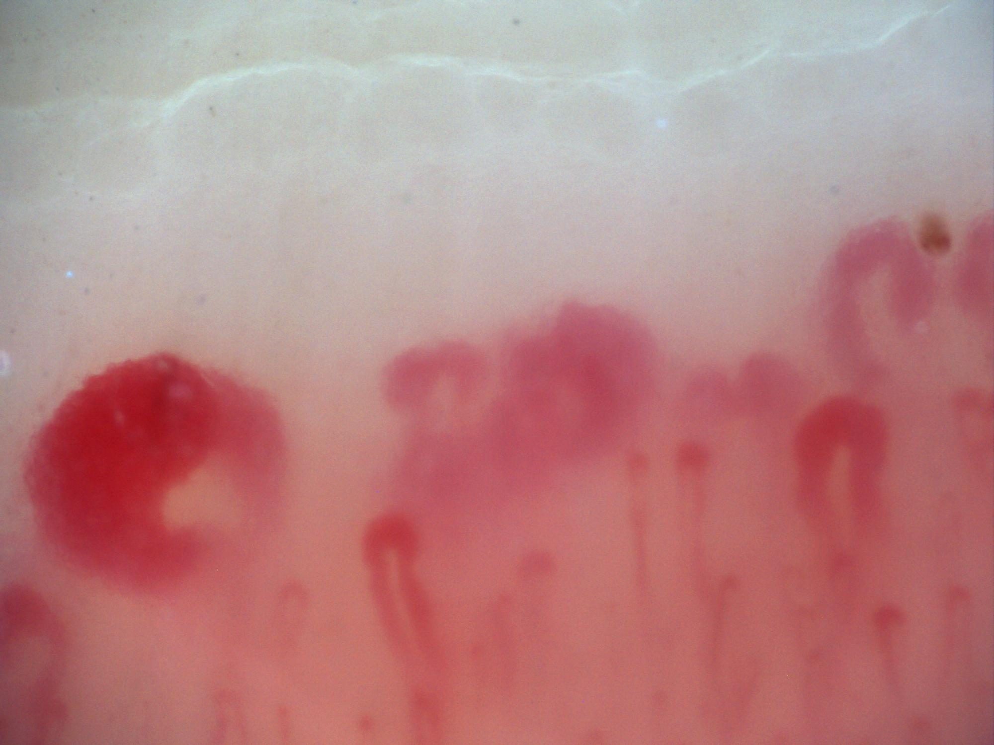 200x capillaroscopy field in systemic sclerosis showing a very large megacapillary