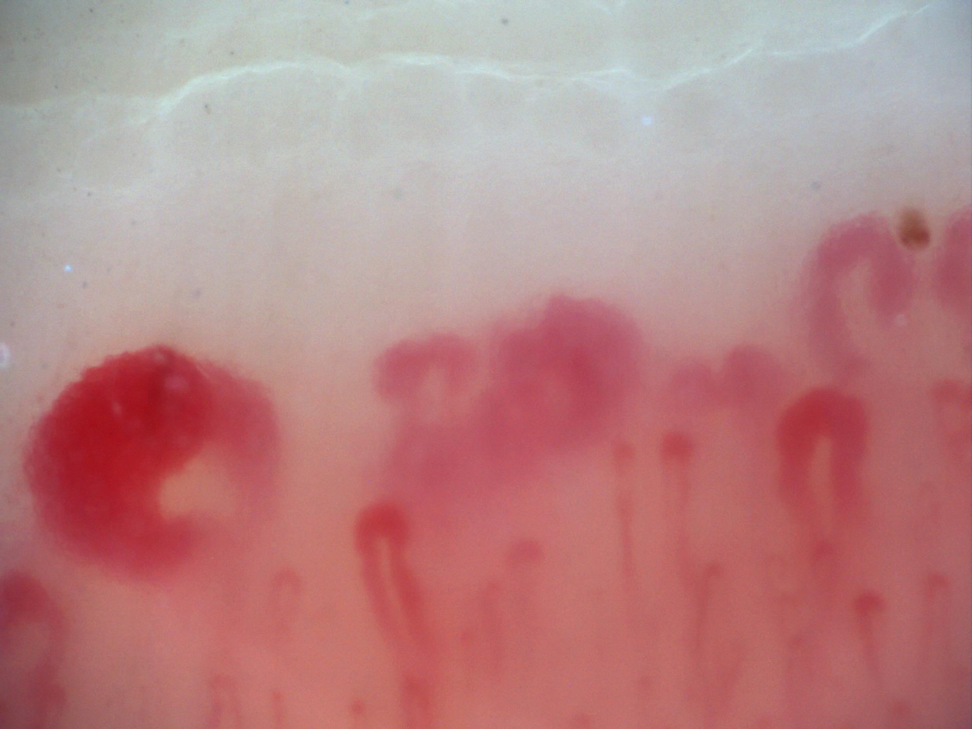 200x capillaroscopy field in systemic sclerosis showing a very large megacapillary