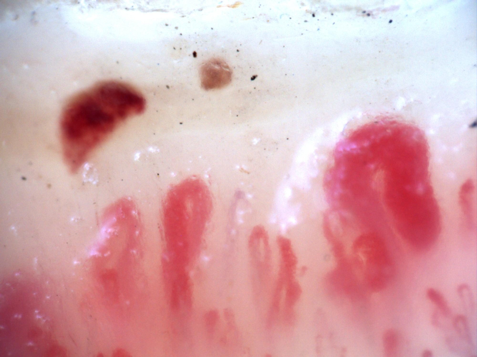 200x capillaroscopy field in systemic sclerosis showing a prominent megacapillary