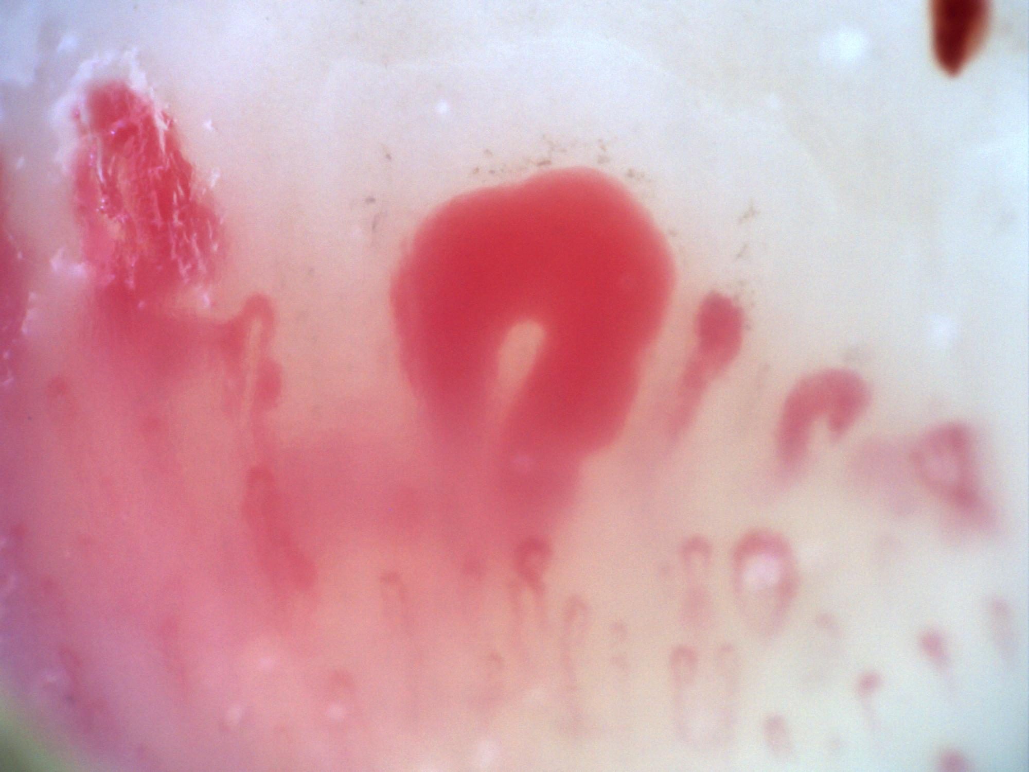 200x capillaroscopy field in systemic sclerosis showing very dilated megacapillaries
