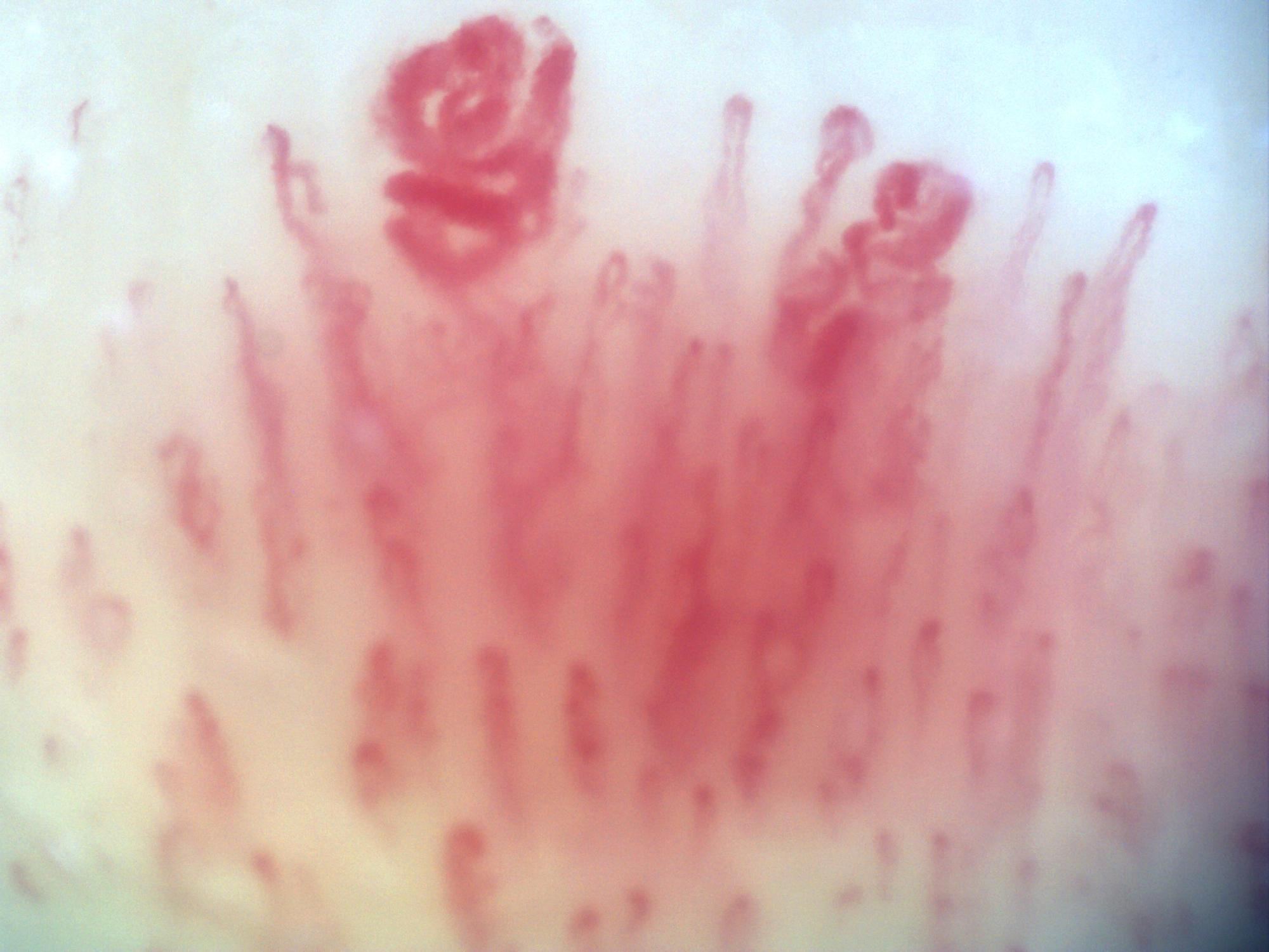 200x capillaroscopy field showing a giant capillary with a coiled appearance
