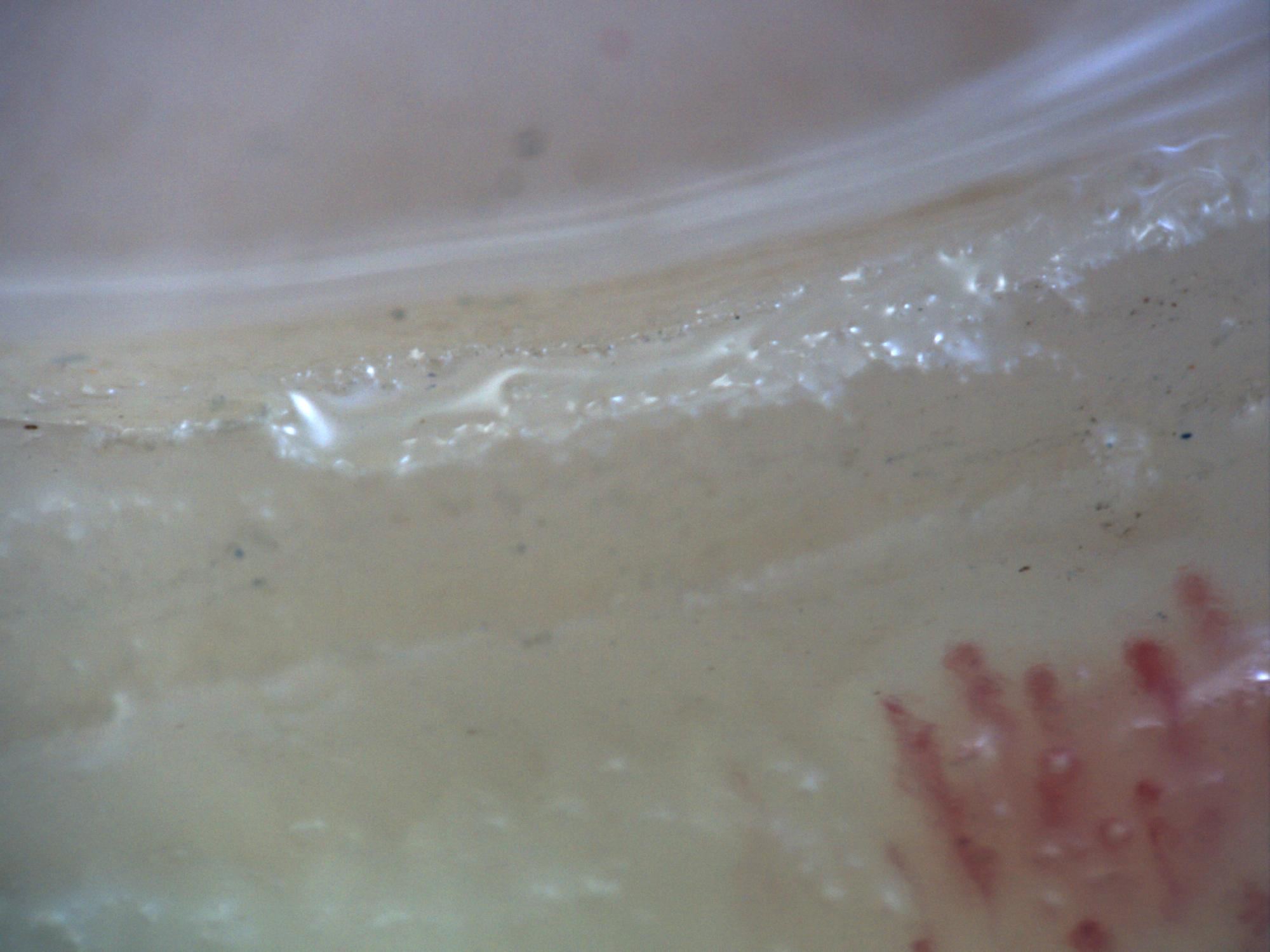 200x capillaroscopy field with disappearance of the capillary bed on the left margin due to excessive pressure on the nail