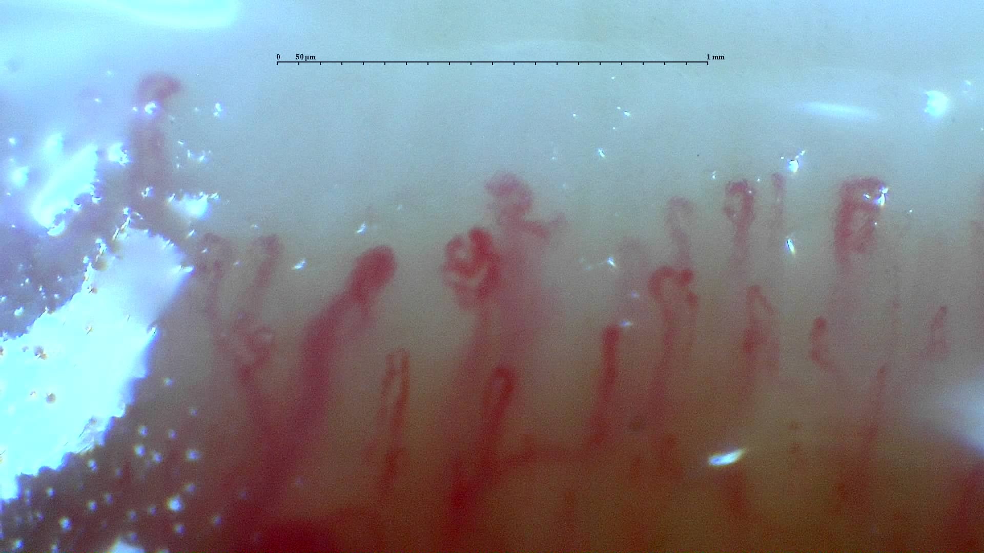 Preview image for Mixed Connective Tissue Disease with an Unclassifiable Scleroderma-Like Pattern